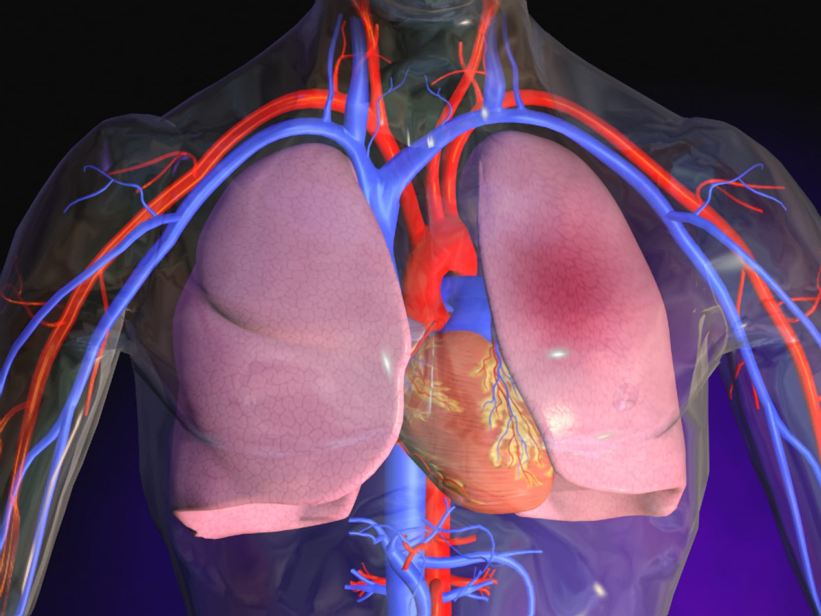 Pulmonary Embolism - BIMC Hospital