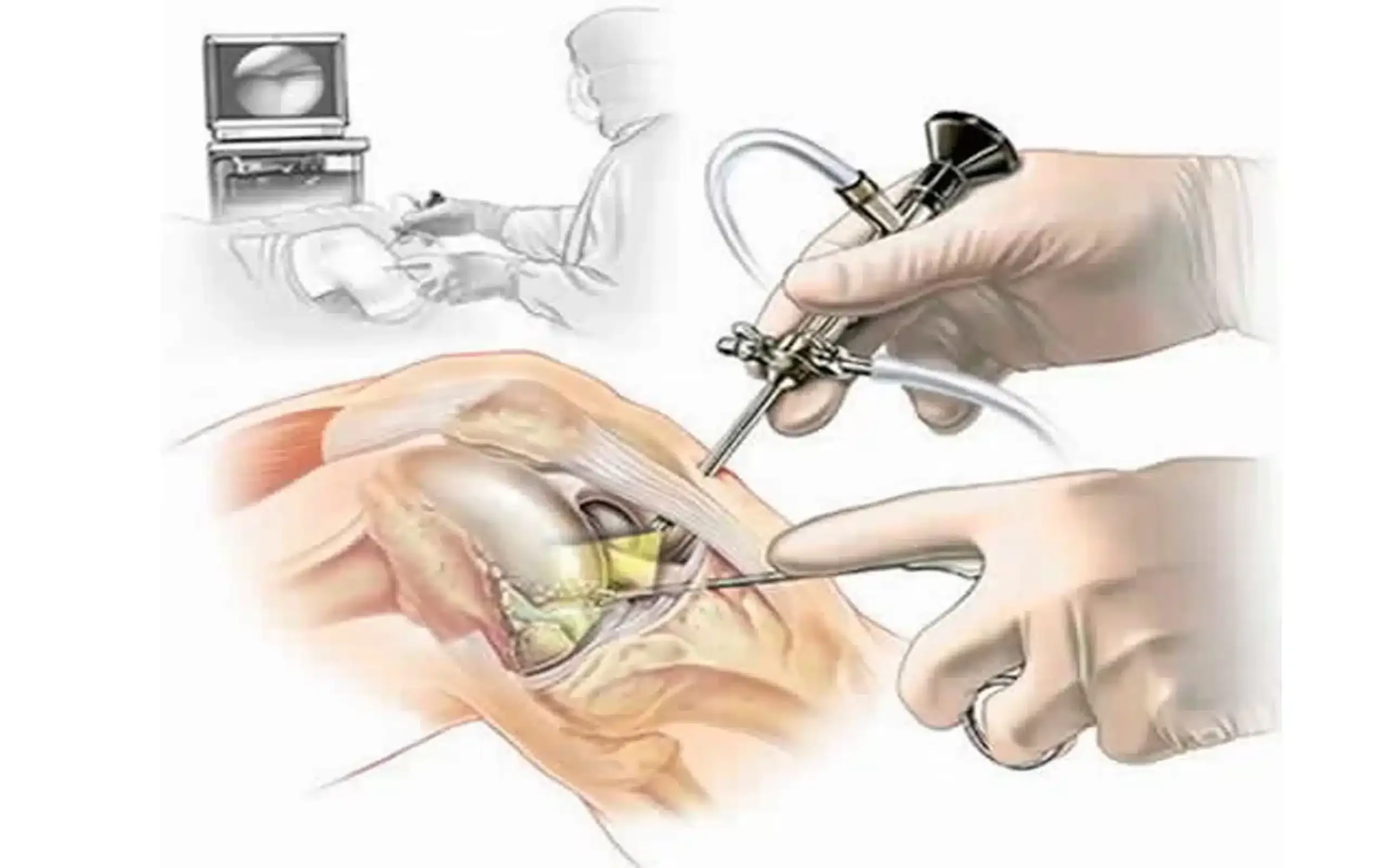Arthroscopic Surgery