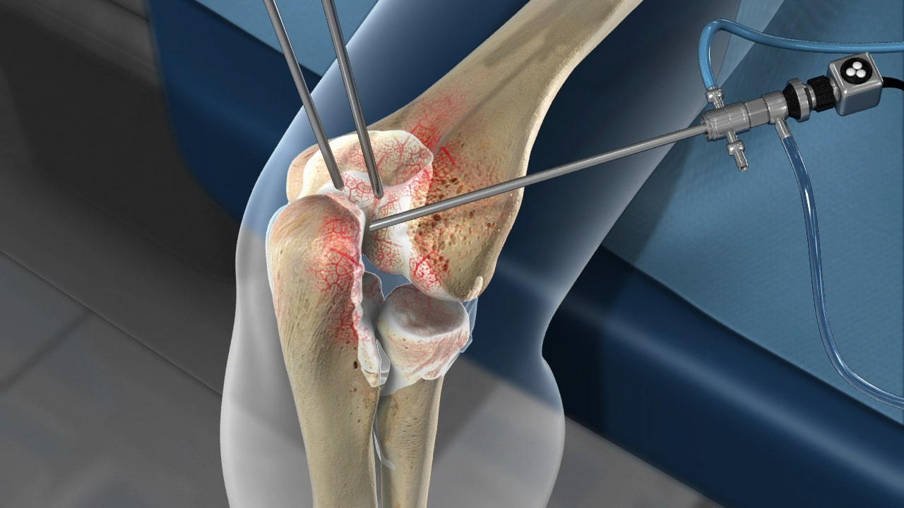Arthroscopy Procedure