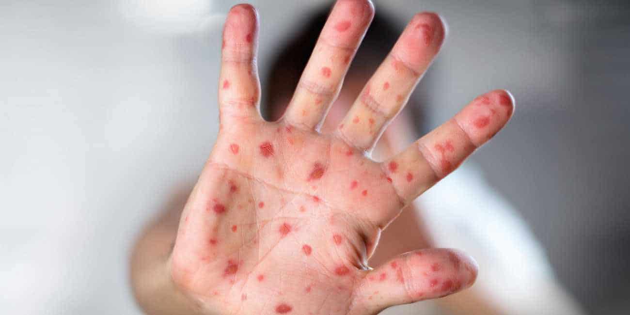 bali measles update