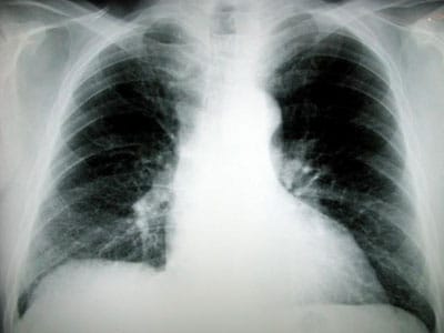 Chronic-cough
