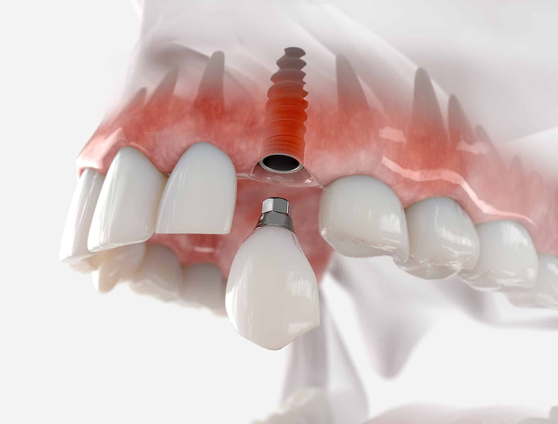 Replacement,of,maxillary,canine,with,a,dental,implant.,realistic,3d