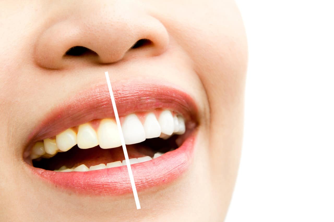 Dental Whitening Di Bimc Nusa Dua Hospital