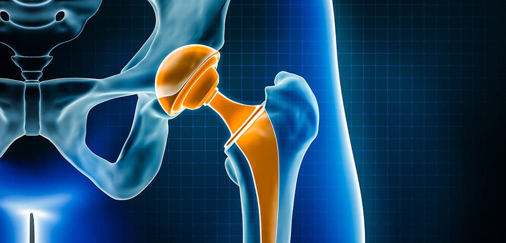 Free Through Total Hip