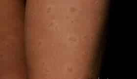 Hives