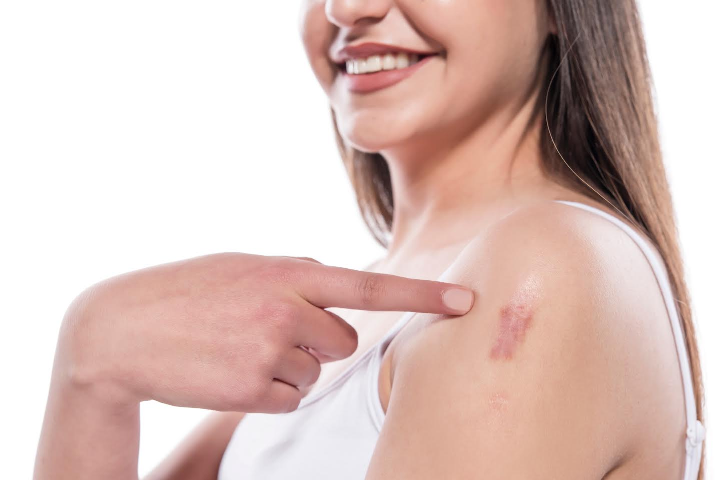 Keloid Removal Solusi Jitu Untuk Mengatasi Bekas Kulit Menonjol