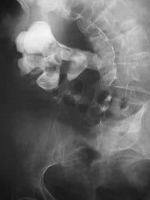 Kidney stones