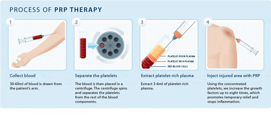 Process PRP