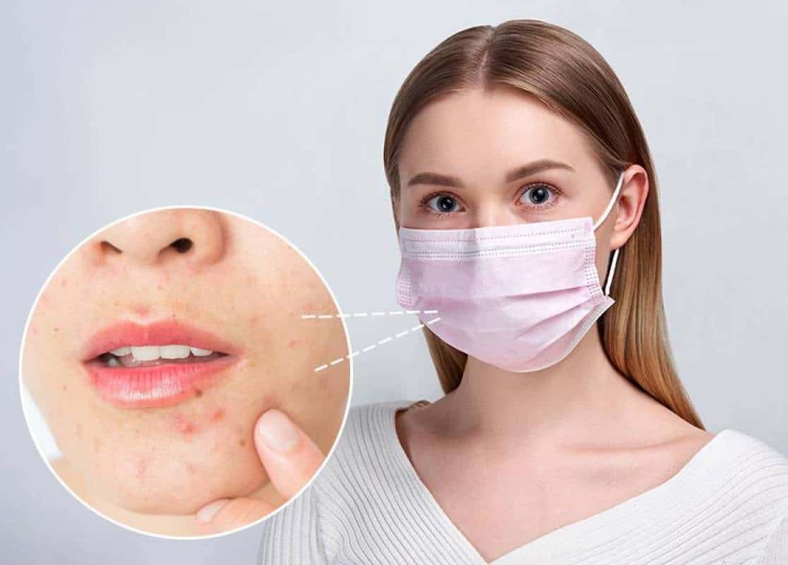 Mencegah Maskacne