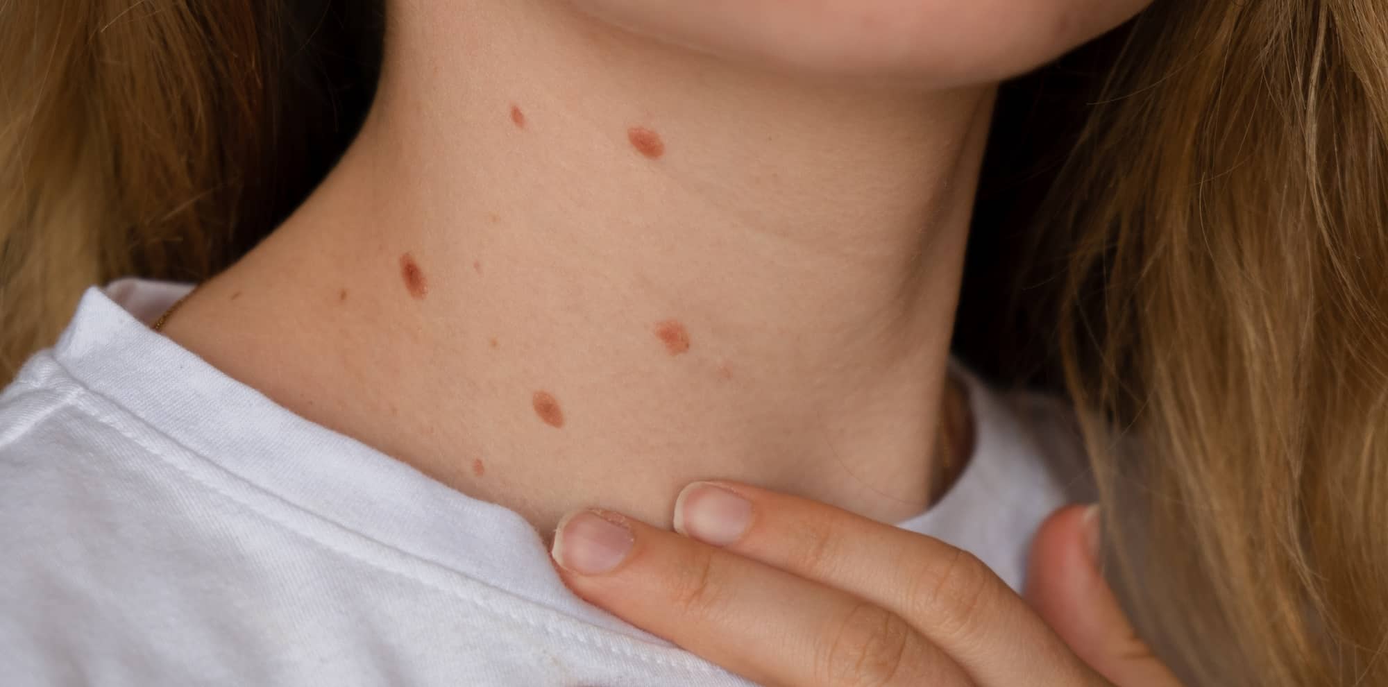 Unrecognizable Woman Showing Her Birthmarks On Neck Skin Close Up Detail Of The Bare Skin Sun Exposure Effect On Skin, Health Effects Of Uv Radiation Woman With Birthmarks Pigmentation
