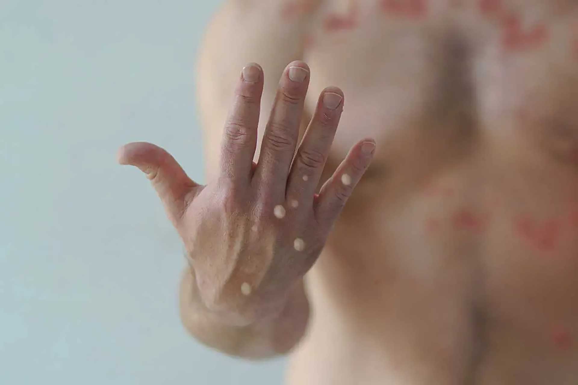 Monkeypox