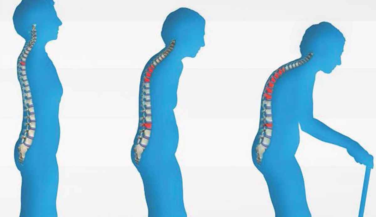 Osteoporosis-web