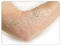 Psoriasis