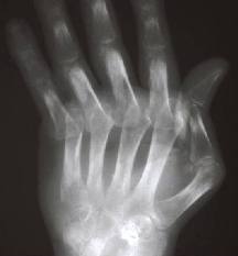 Rheumathoid arthritis