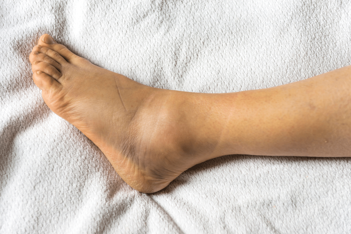 Sprained Ankle
