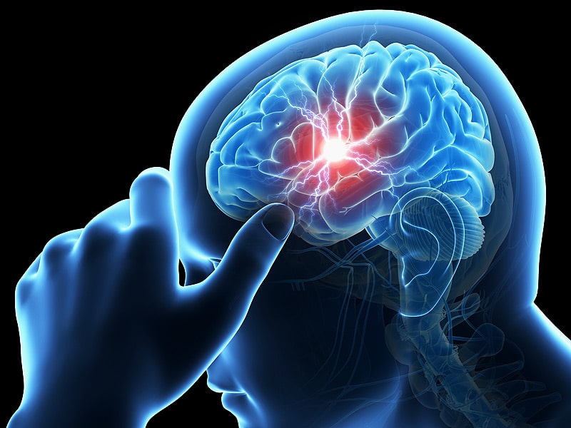 Stroke Res