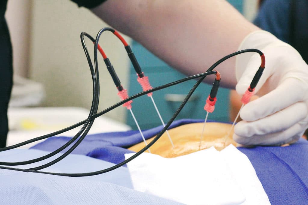 Theraphy Radiofrequency