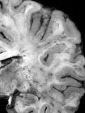 Toxoplasmosis