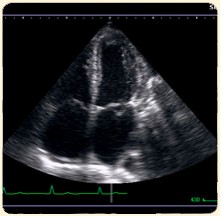 echocardiography