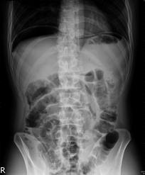 appendicitis
