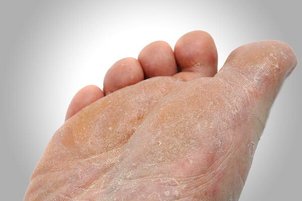 athletes-foot