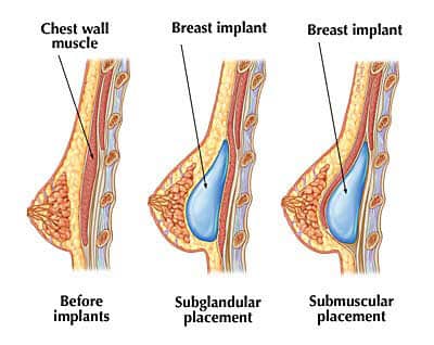 breast-augmentation-surgery