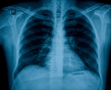 chest_x-ray