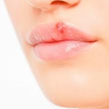 cold sores