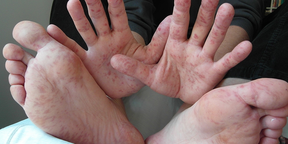 disease
