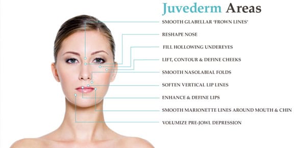 juvederm_BIMC
