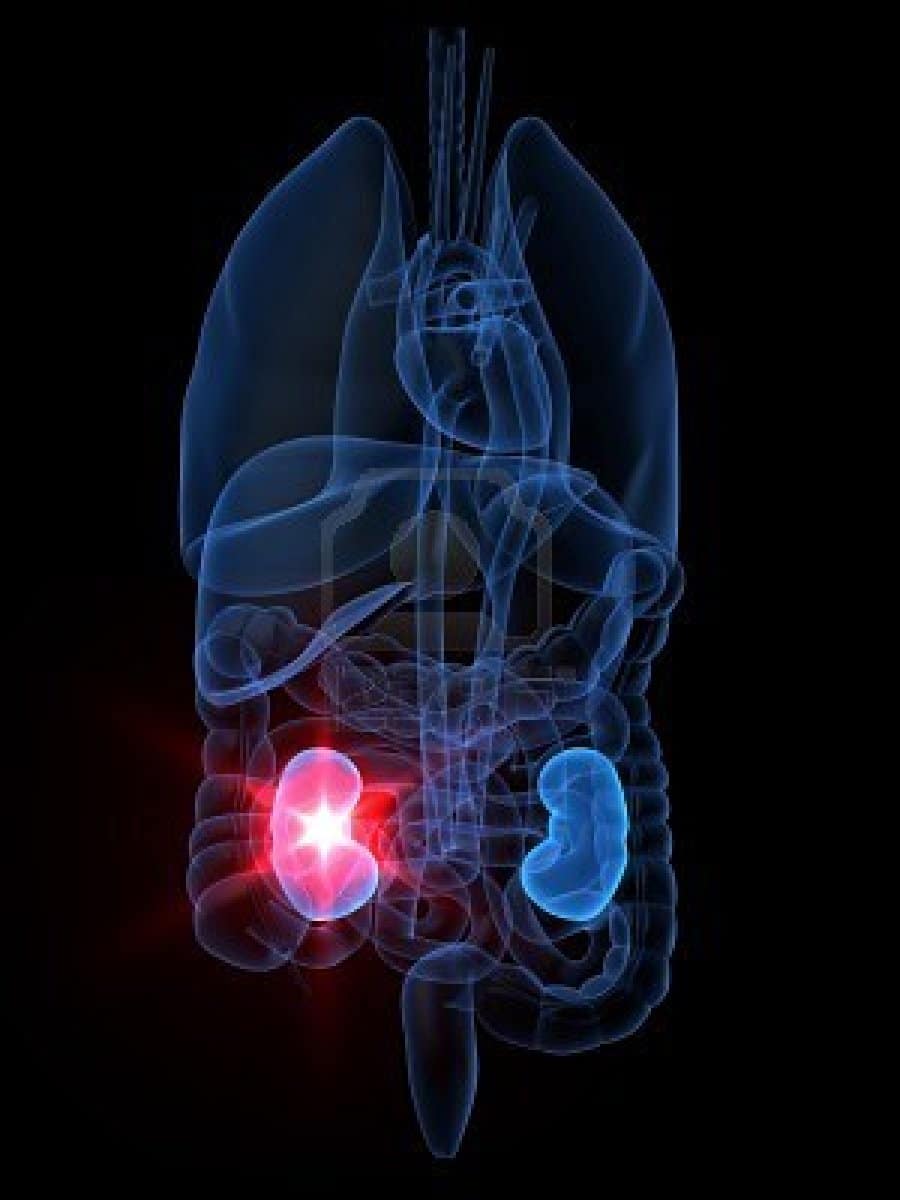 kidney failure