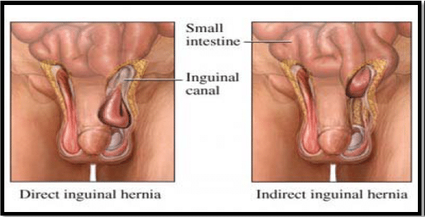 Perbedaan Hernia