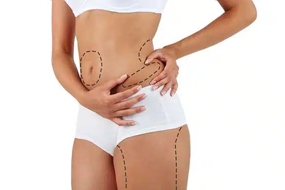 liposuction_bimc