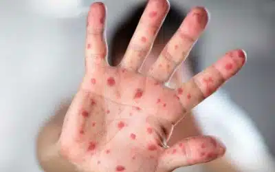 bali measles update