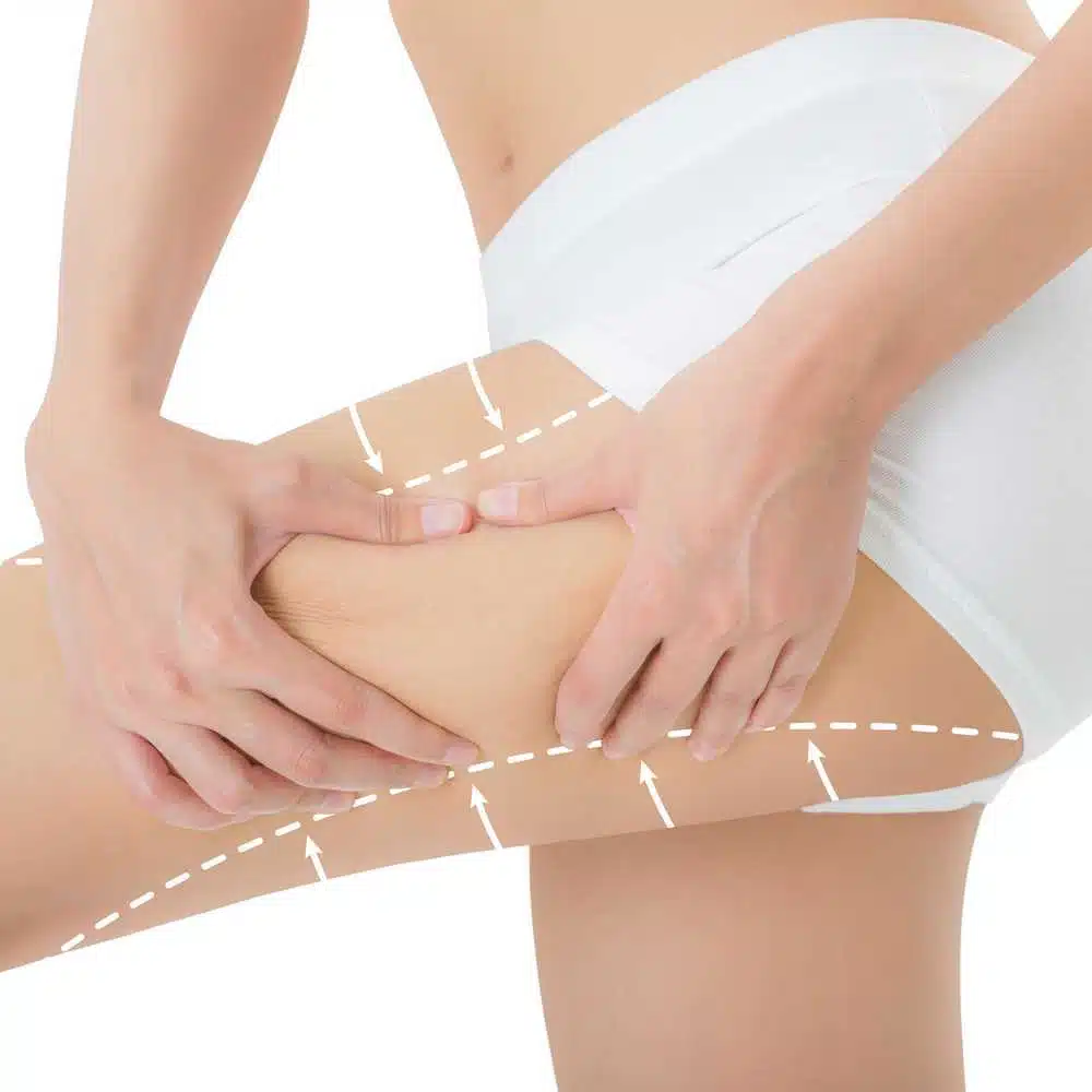Liposuction - Bali plastic surgery Liposuction - Bali plastic surgery