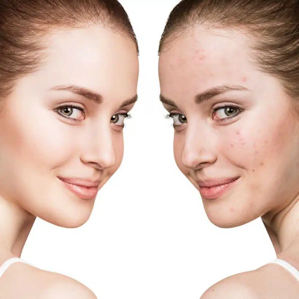 Scar Revision Scar Revision