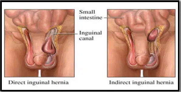 Perbedaan Hernia