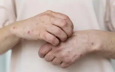 Skin Allergy Person S Arm