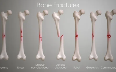 The Various Types Of Fractures