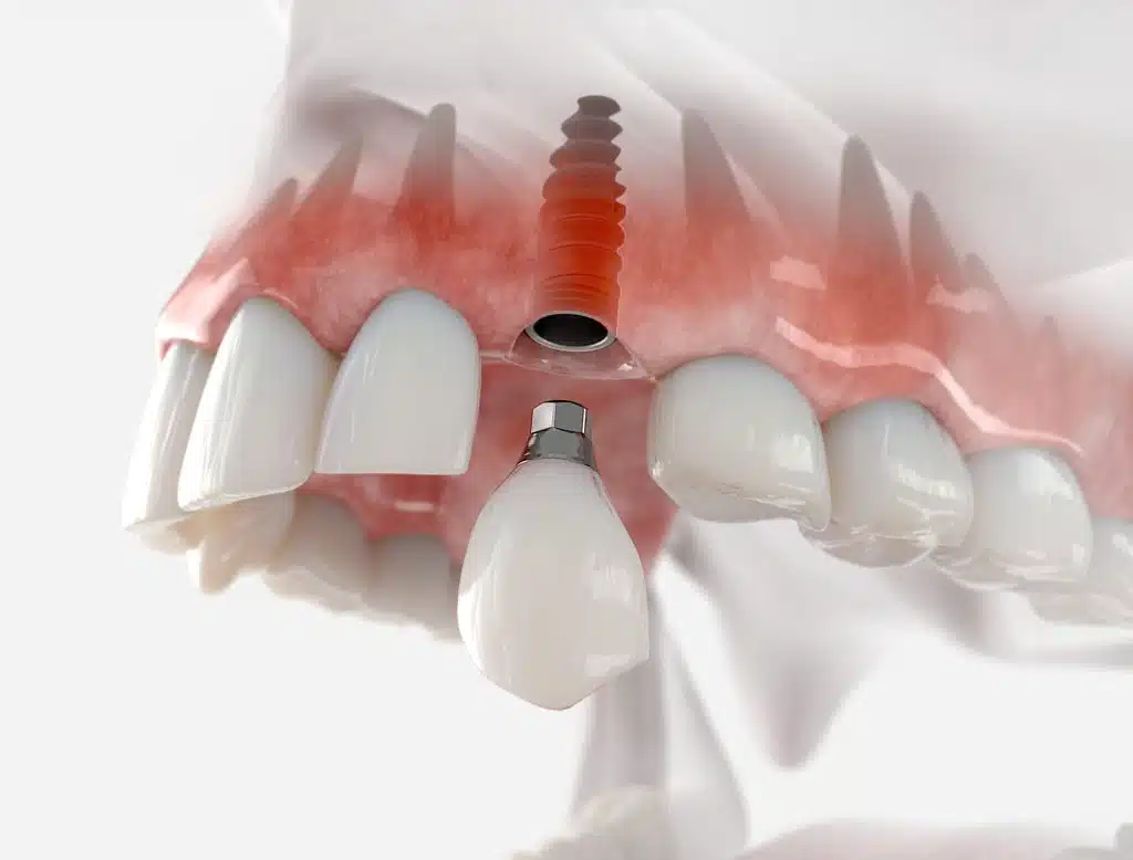 Replacement,of,maxillary,canine,with,a,dental,implant.,realistic,3d