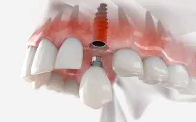 Replacement,of,maxillary,canine,with,a,dental,implant.,realistic,3d