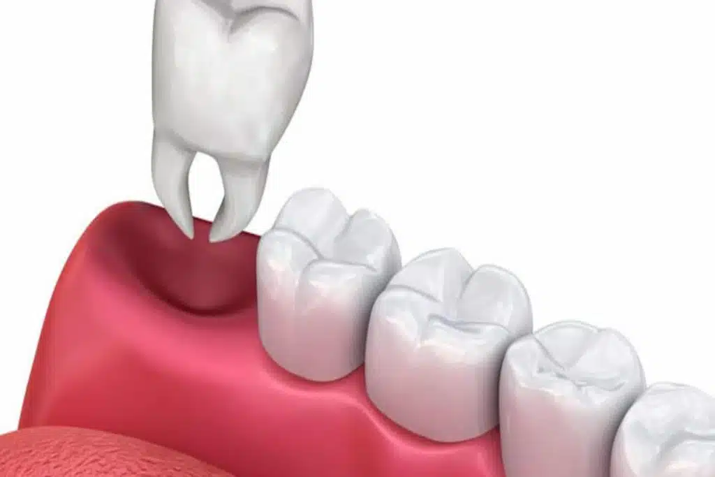 Pulling Upper Teeth
