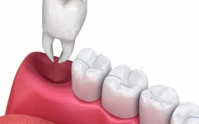 Pulling Upper Teeth