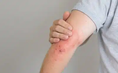 Allergic Reactions How Fast Can They Turn Critical