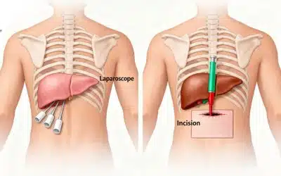 Laparoscopy Vs. Open Surgery Safety, Risks, And Outcomes