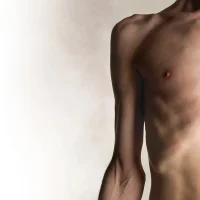 Malnutrition In Adults Copy